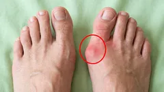 Sano hyvästit jalkojen luille: 6 harjoitusta, jotka samalla rentouttavat jalkoja