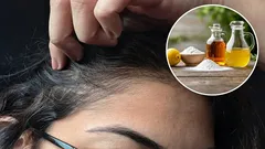 Mitkä ovat etikan ja ruokasoodan käytön edut harmaiden hiusten poistamisessa ja miten se tehdään oikein?